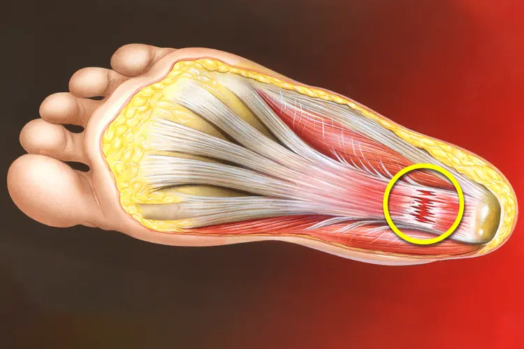 Platelet-Rich Plasma Efficacy in Treating Plantar Fasciitis plantar fascia tissue
